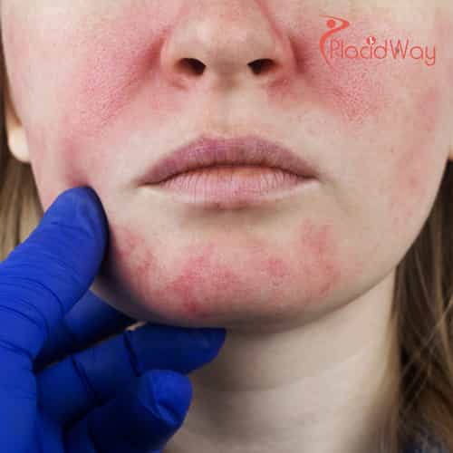 V-Beam Laser Treatments in Korea for Rosacea Control and Facial Redness Reduction